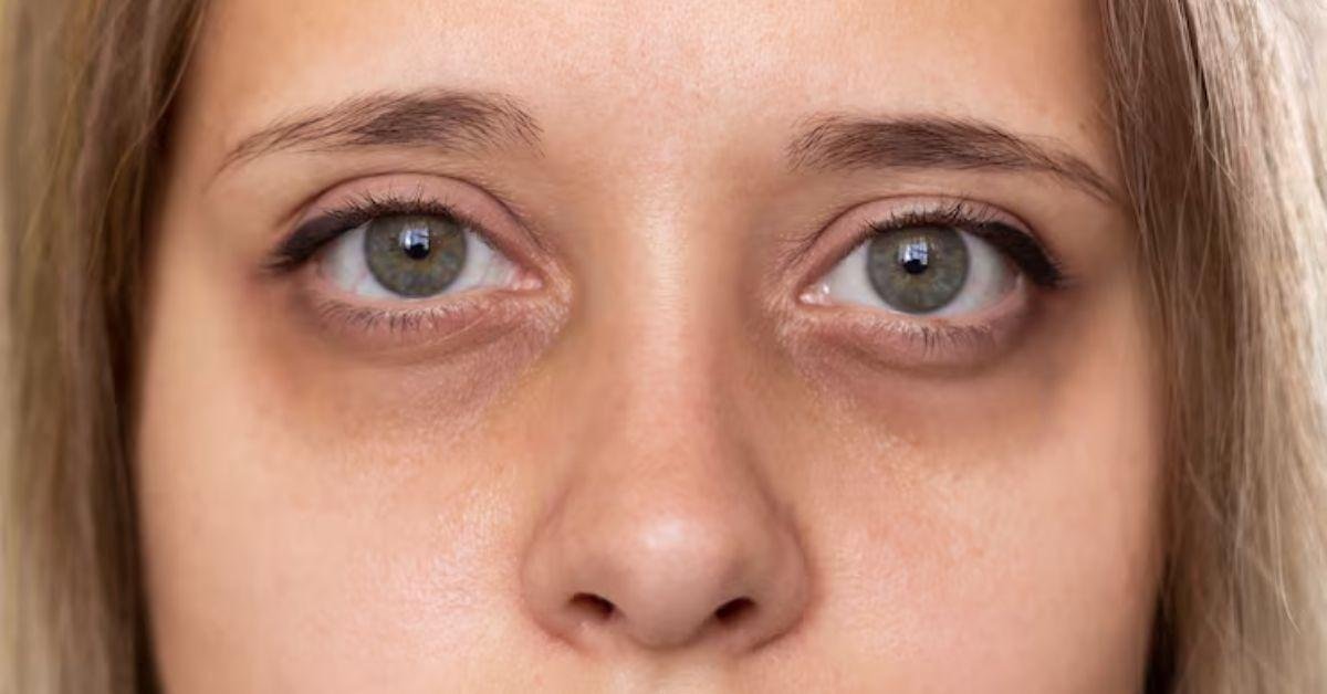 Close-up of under-eye dark circles before treatment