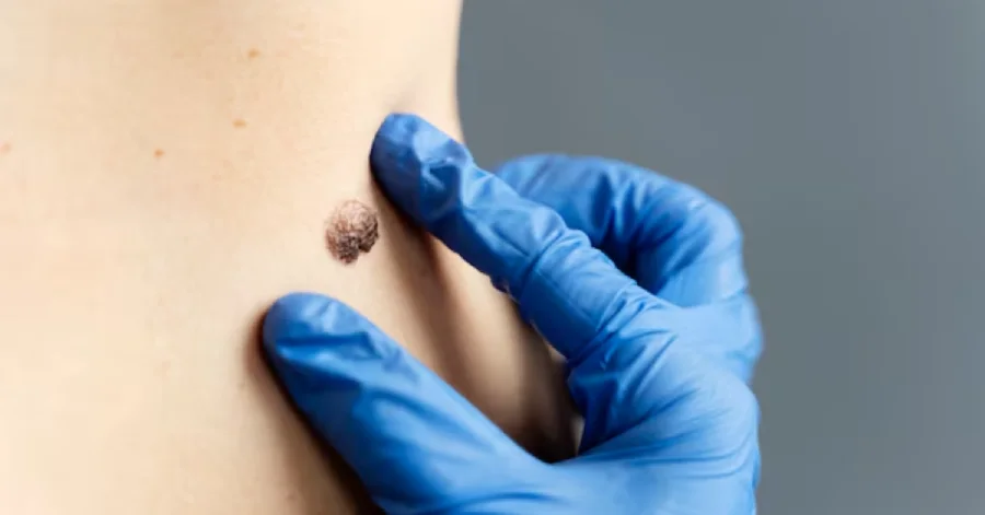 What Is a Mole?