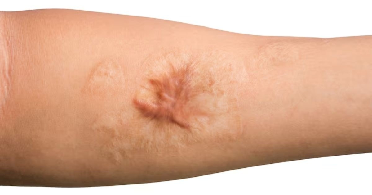 Keloid Scars