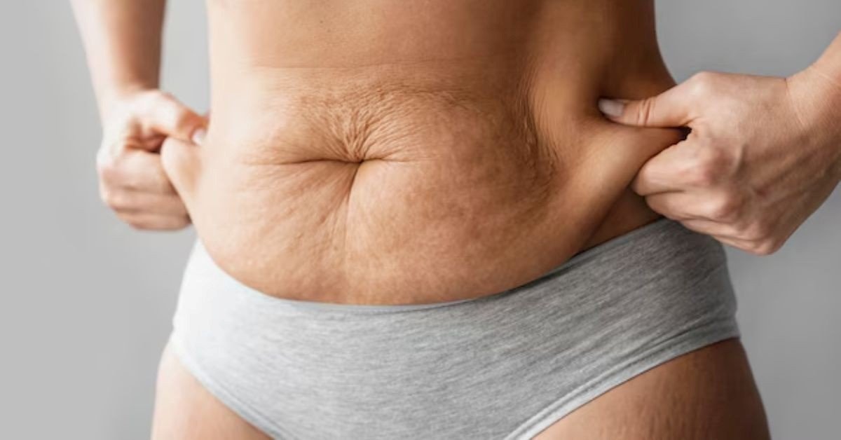 Stretch Marks