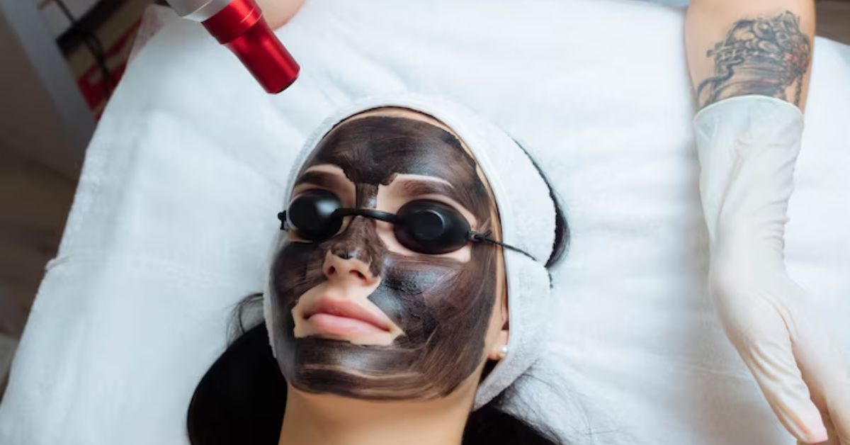 carbon facial benefits